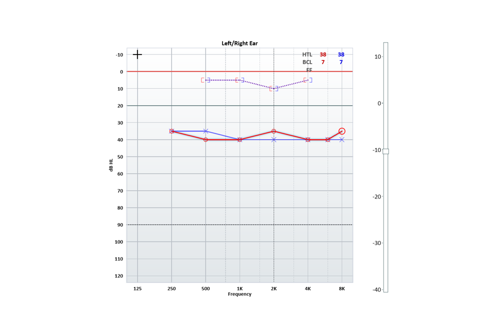 Conductive Hearing Loss Audiogram